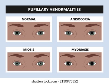 Arten von Pupillenanomalien der Augen, die zum Horner-Syndrom führen können