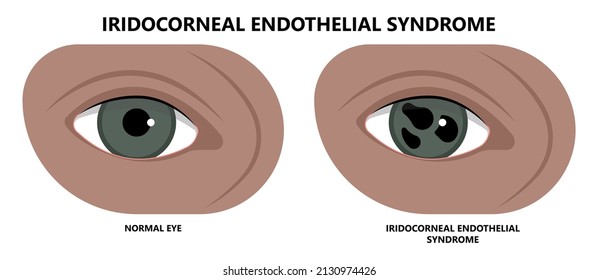 Miosis Eye Pupil Size Iris Retina Brain Horner Miotic Muscle Dilated Ocular Injury Ptosis Reflex Marcus Gunn Defect Optic Nerve Test Palsy Trauma Birth Adie Tonic Argyll Hutchinson Blind Diplopia Exam