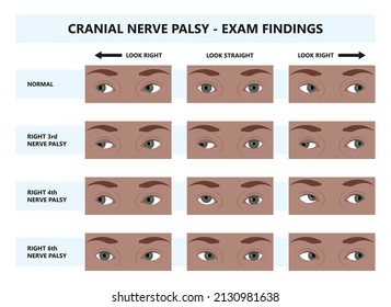 miosis eye pupil size iris retina brain Horner miotic muscle dilated ocular injury ptosis reflex Marcus Gunn defect optic nerve test palsy Trauma birth Adie tonic argyll hutchinson blind diplopia exam