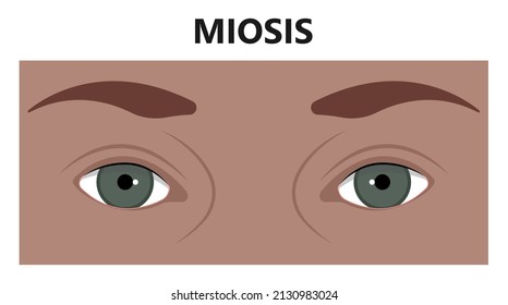 miosis eye pupil size iris retina brain Horner miotic muscle dilated ocular injury ptosis reflex Marcus Gunn defect optic nerve test palsy Trauma birth Adie tonic argyll hutchinson blind diplopia exam