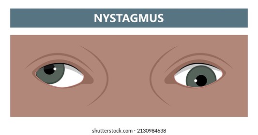 miosis eye pupil size iris retina brain Horner miotic muscle dilated ocular injury ptosis reflex Marcus Gunn defect optic nerve test palsy Trauma birth Adie tonic argyll hutchinson blind diplopia exam