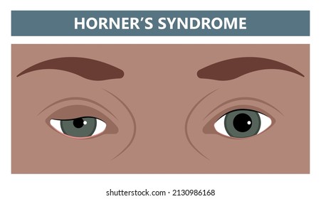 miosis eye pupil size iris retina brain Horner miotic muscle dilated ocular injury ptosis reflex Marcus Gunn defect optic nerve test palsy Trauma birth Adie tonic argyll hutchinson blind diplopia exam