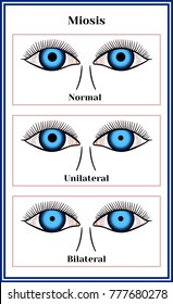 acute unilateral miotic pupil acute unilateral miotic pupil