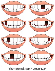 Missing Tooth Series