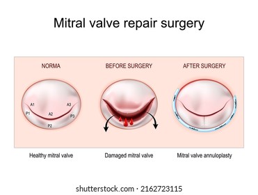 Mitral Valve Repair Surgery. Healthy Mitral Valve. Damaged Mitral Valve Before And After Annuloplasty. Vector Illustration