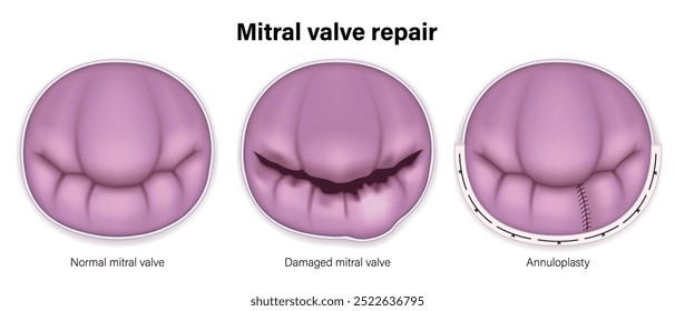 Mitralklappenreparaturvektor. Normale Mitralklappe, beschädigte Mitralklappe und Annuloplastik.