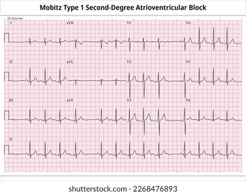 Mobitz Type 1 Second Degree Atrioventricular Block - ECG Paper 12 Lead - Electrocardiogram - Vector Medical Illustration