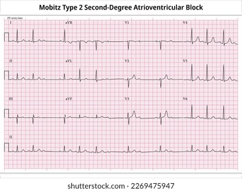 Mobitz Type 2 Second Degree Atrioventricular Block - ECG Paper 12 Lead - Electrocardiogram - Vector Medical Illustration