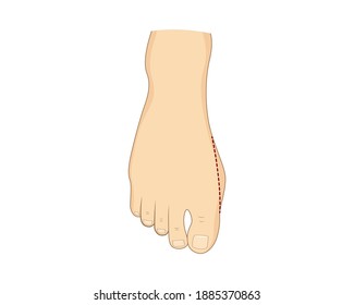 Moderate bunion surgery correction. Vector illustration. Medical orthopedics