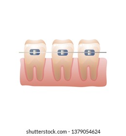 Modern steel, metal dental braces for young or old people
