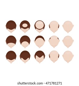 Modern vector illustration of baldness. Hair loss stages set. Different stage of baldness.