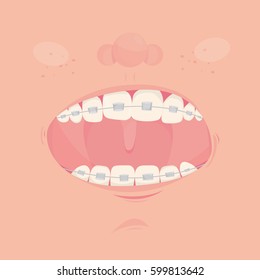 Modern vector illustration of braces on teeth. Dental healthcare.