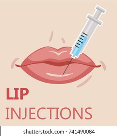 Ilustración vectorial moderna de las inyecciones de labios. Aumento del labio. Inyecciones de Ácido Hialurónico