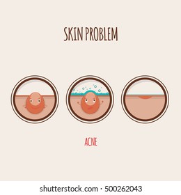 Modern vector illustration of skin problems. Dark dots, acne. Face care.