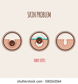 Modern vector illustration of skin problems. Dark dots, acne. Face care.