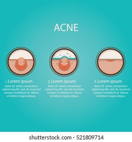 Modern vector illustration of skin problems. Dark dots, acne. Face care. Template for website.