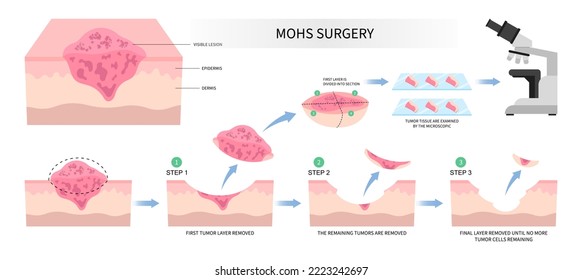 Mohs surgery basal cell microscopic reconstruction Paget's disease inflammation biopsy