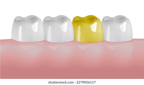 Molar teeth implant, bridge or veneer treatment for missing tooth surgery restoration. Artificial prosthesis or oral crown as row gap filling