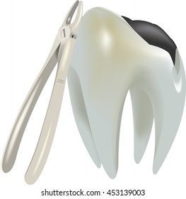 molar tooth with tooth decay and forceps extraction