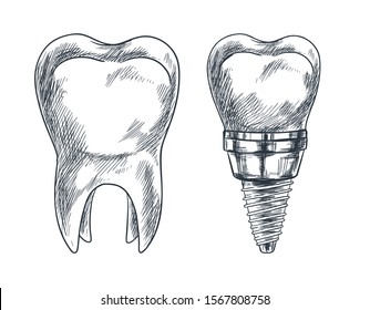 Molar tooth and implant, prothesis, sketch vector illustration, hand drawn stomatology icon.