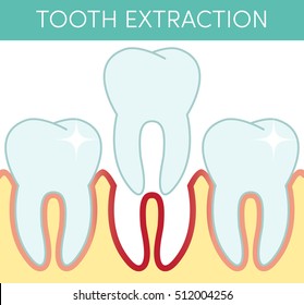 Molar tooth removal. Vector cartoon illustration