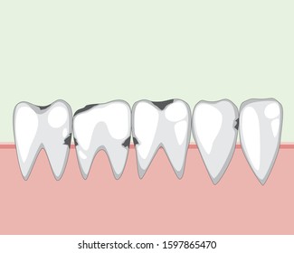 A molars and incisors on the gums are affected by caries before visiting a dentist or orthodontist. A vector stock illustration with flat teeth of adult or child for dental clinic