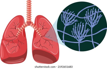 The mold spores grow in human lungs illustration