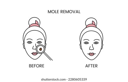Mole removal, laser cosmetology before procedure and after applying treatment line icon in vector. Illustration of a woman with smooth clean skin and problematic skin.
