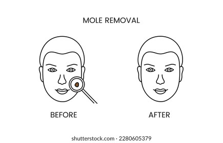Mole removal, laser cosmetology before procedure and after applying treatment line icon in vector. Illustration of a man with smooth clean skin and problematic skin