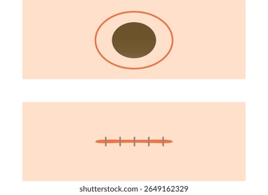 Remoção de touca e ilustração de método de sutura

