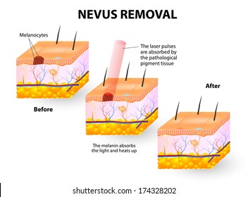 Moles spots can be removed with lasers. Vector illustration