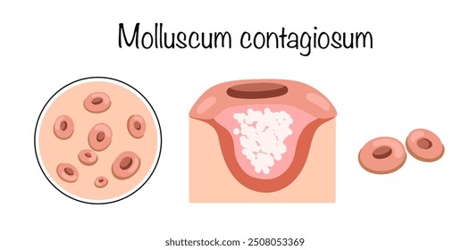 Molluscum contagiosum. A skin disease caused by a viral infection. Manifestation of the disease on the skin in the form of a characteristic rash. Vector illustration.