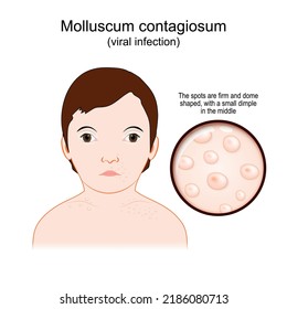 Molluscum Contagiosum. Water Warts Is A Viral Infection That Caused The Spots On The Skin Condition. Vector Poster.