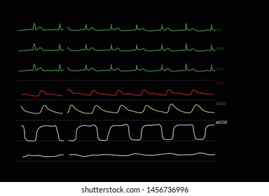 Monitoring Graph Displays Of Patient Vital Signs Of Anesthesiology In Operating Room. Vector Illustration