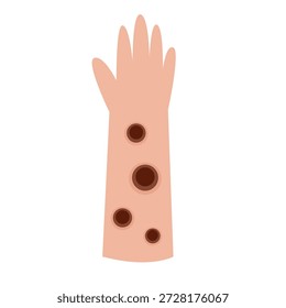 monkey pox, Mpox disease skin symptom concept
