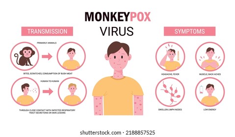 Monkey pox outbreak. Infographics of virus symptoms in humans and transmission. Vector illustration for informing people about an infectious disease.