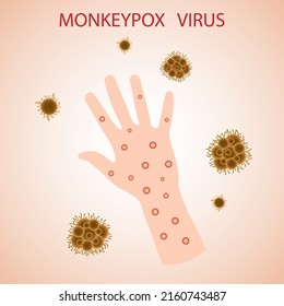 Monkey pox virus on the skin. The monkey pox virus is a viral disease that can affect humans and non-human primates. Monkey pox. Vector illustration