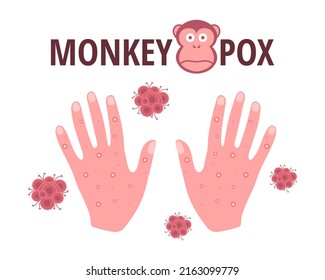 Monkey pox virus. Vector design with skin rash on the hands, symptom of an infectious disease