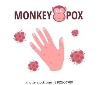 Monkey pox virus. Vector design with skin rash on the hand, symptom of an infectious disease.