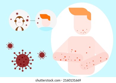 monkeypox concept,infographic shows the spread of monkeypox virus from monkeys to humans and the blisters on the skin when infected.monkeypox cell flat design,vector illustration.