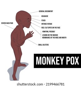 Monkeypox, Or Monkeypox, Is A Jungle Zoonosis With Incidental Human Infections.