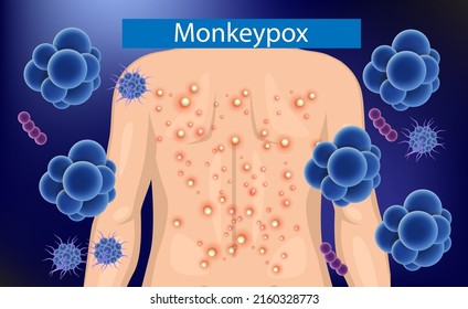 Monkeypox on human back. Human body. Monkey pox virus outbreak  Vector.