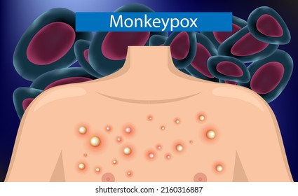 Monkeypox on human body. Monkey pox virus outbreak  Vector.