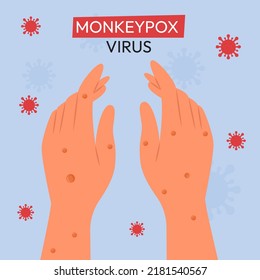 Ausbruch von Monkeypox. Monkeypox wird auf der Hand des Patienten angezeigt. Flache Vektorgrafik zur Information der Menschen über eine Infektionskrankheit.