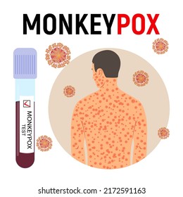 Monkeypox Pandemic Poster. Smallpox Man, Test Tube With Blood With A Positive Test And Virus Cells. Viral Disease. Vector Illustration.