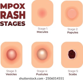 monkeypox rash stages on skin - vector