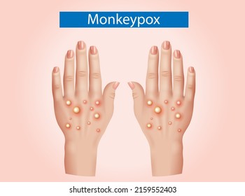 Monkeypox are shown on patient's hand