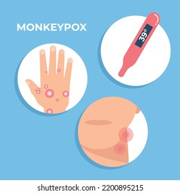 Monkeypox Signs and Symptoms, vector