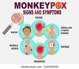 Monkeypox. Signs and symptoms of monkeypox virus. Fever, headache, rash, muscle aches, swollen lymph nodes, fatigue. Мonkeypox outbreak. infectious disease. Health care in USA, Europe and Asia.