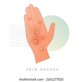 Monkeypox - Skin Rashes and Spots as Symptoms - Icon as EPS 10 File